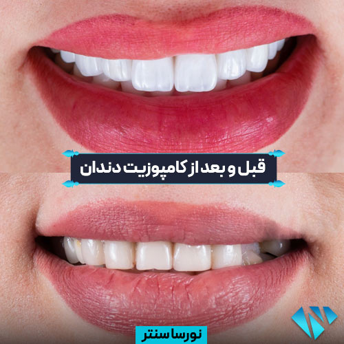 قبل و بعد کامپوزیت دندان