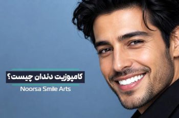 کامپوزیت ونیر چیست؟