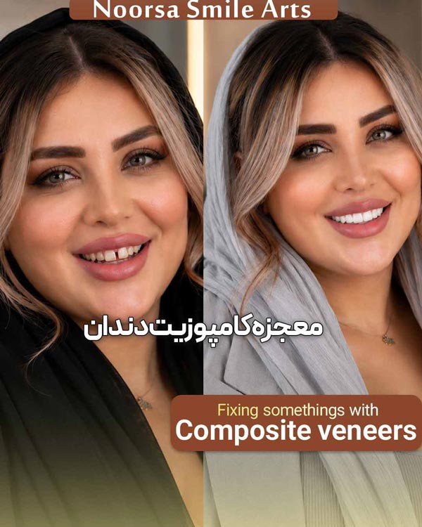 قبل و بعد کامپوزیت دندان