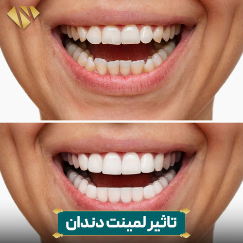 لمینت دندان