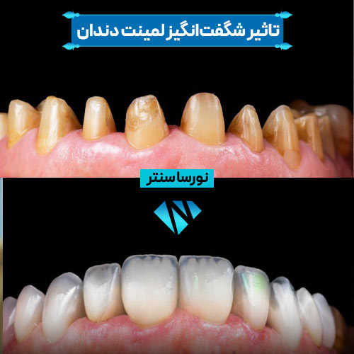 قبل و بعد لمینت دندان
