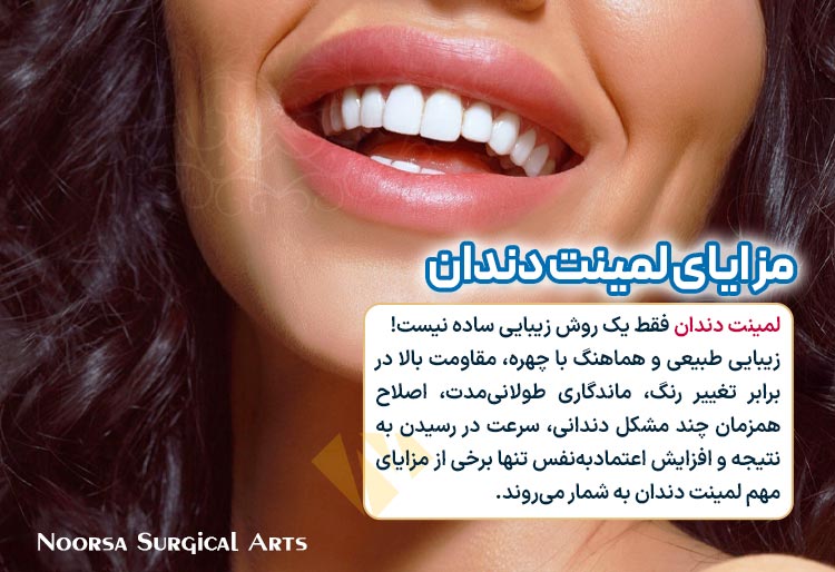 مزایای لمینت دندان