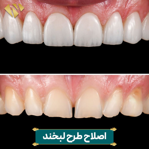 اصلاح طرح لبخند با لمینت
