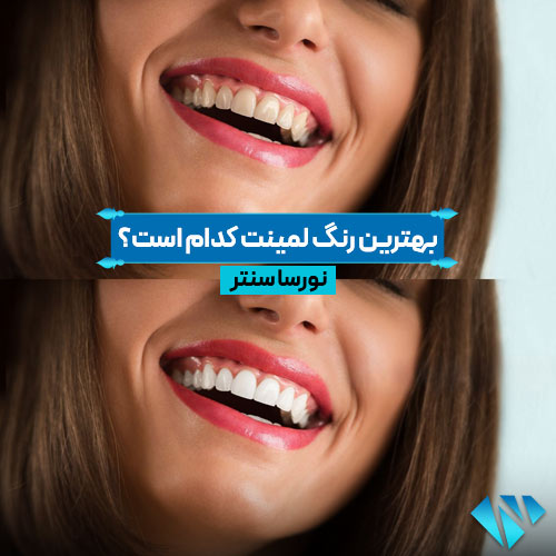بهترین رنگ لمینت دندان کدام است