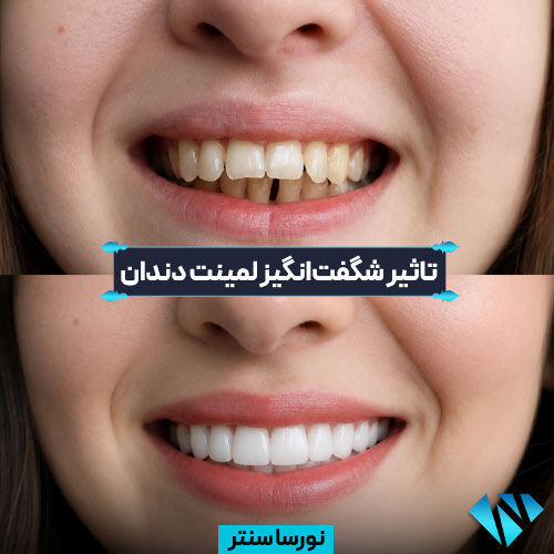 قبل و بعد لمینت دندان