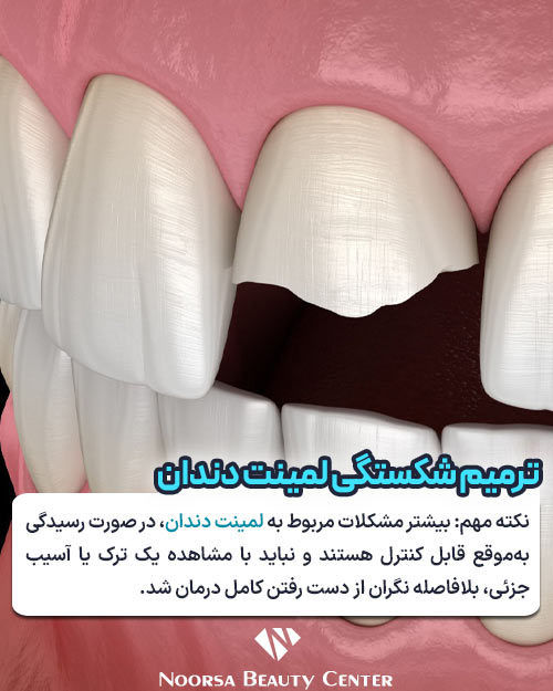 ترمیم شکستگی لمینت دندان