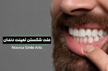 علت شکستن لمینت دندان
