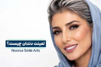 لمینت دندان چیست