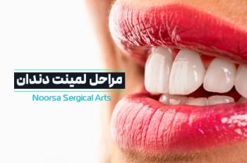 مراحل لمینت دندان
