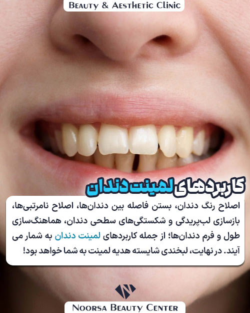 کاربردهای لمینت دندان