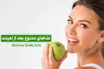 غذاهای ممنوع بعد از لمینت