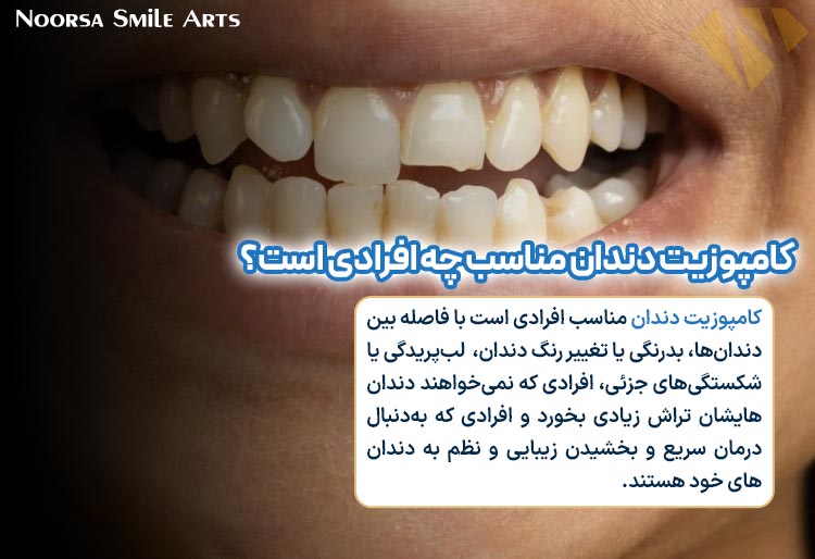 کاندیدای مناسب کامپوزیت دندان