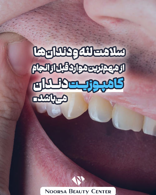 سلامت لثه برای کامپوزیت