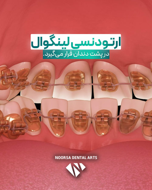 ارتودنسی لینگوال پشت دندان ها قرار میگیرد