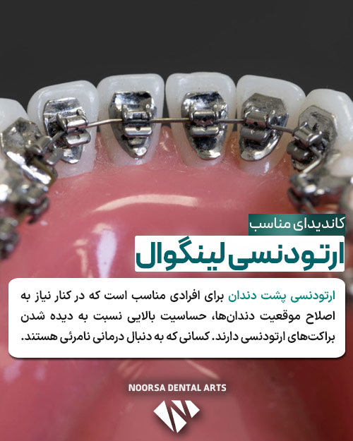 ارتودنسی پشت دندان مناسب چه کسی است؟