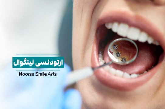 ارتودنسی لینگوال پشت دندان