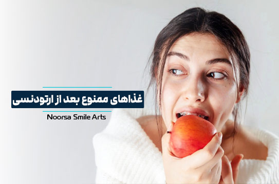 غذاهای ممنوع بعد از ارتودنسی دندان