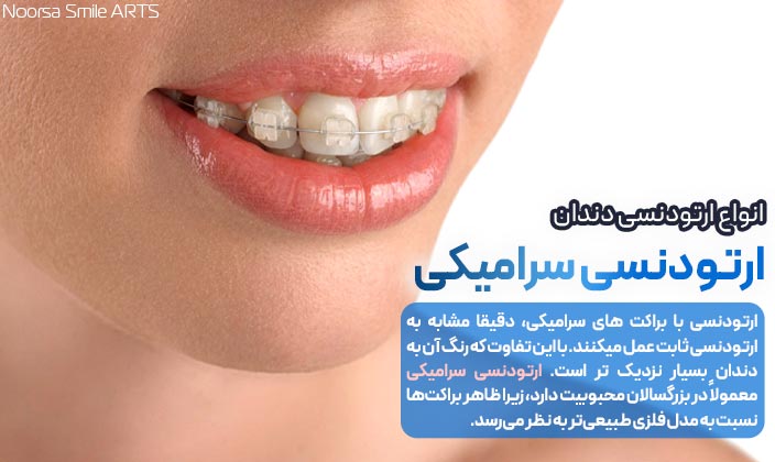 ارتودنسی سرامیکی