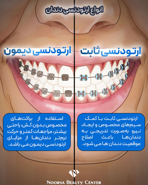 ارتودنسی دیمون