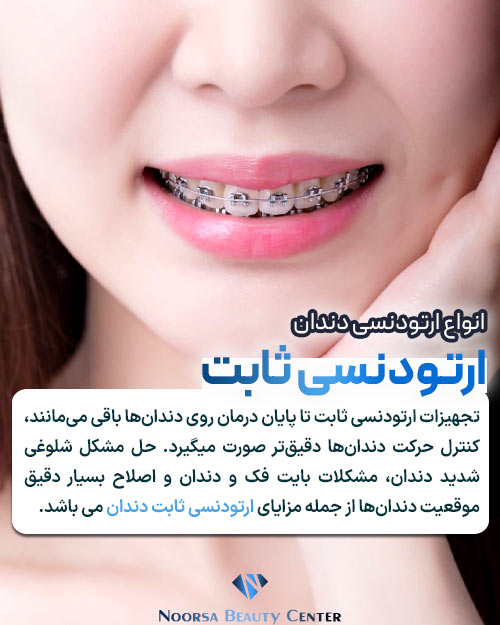 ارتودنسی ثابت دندان