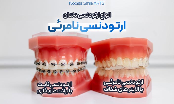 ارتودنسی متحرک دندان