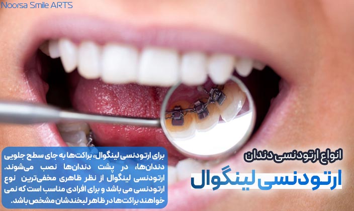 ارتودنسی لینگوال