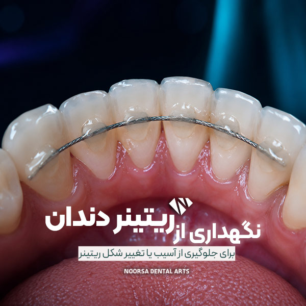 نگهداری از ریتینر دندان