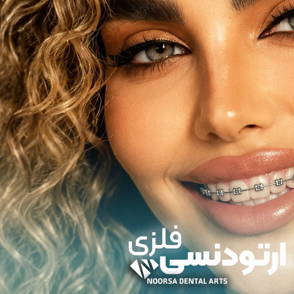 ارتودنسی براکت فلزی