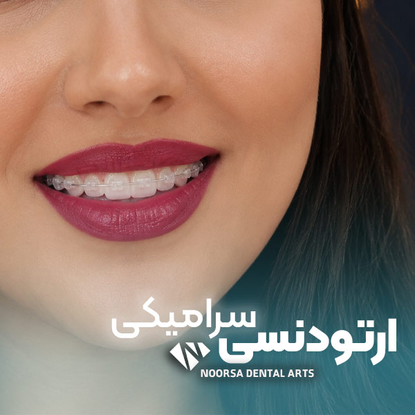 ارتودنسی سرامیکی