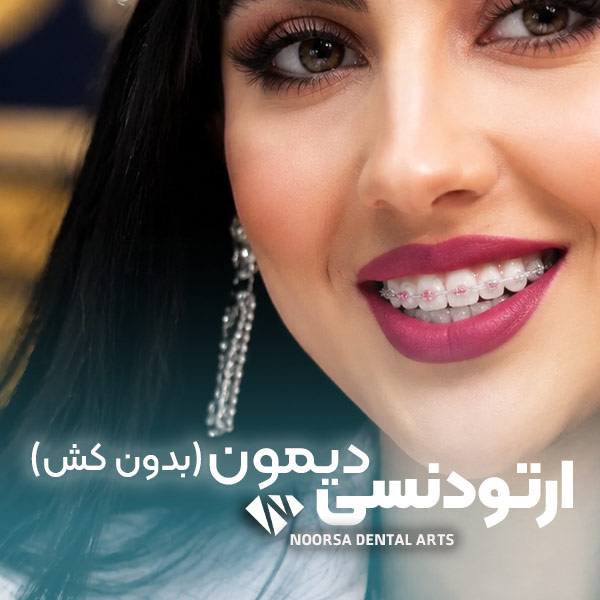 ارتودنسی دیمون (بدون کش)