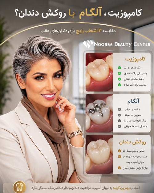 مقایسه کامپوزیت، آلگام و روکش دندان عقب