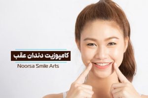 کامپوزیت دندان عقب