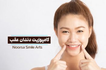 کامپوزیت دندان عقب