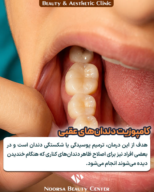 علت کامپوزیت کردن دندان های عقب