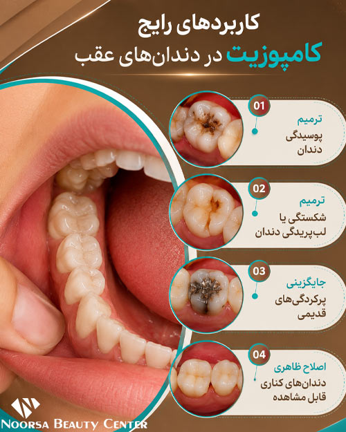 کاربردهای کامپوزیت دندان عقب