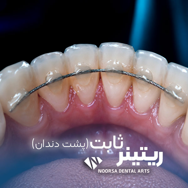 ریتینر ثابت مخفی