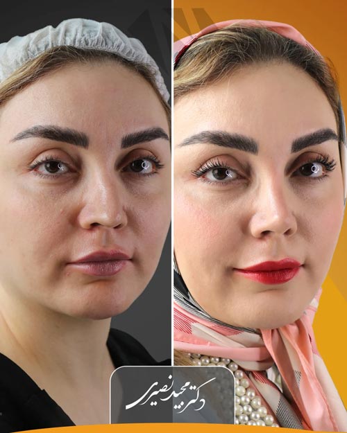 قبل و بعد از جراحی بینی