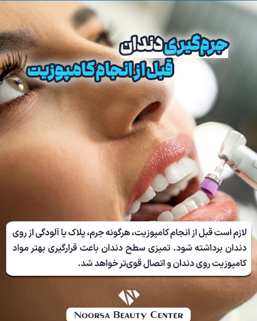 جرم گیری قبل از کامپوزیت
