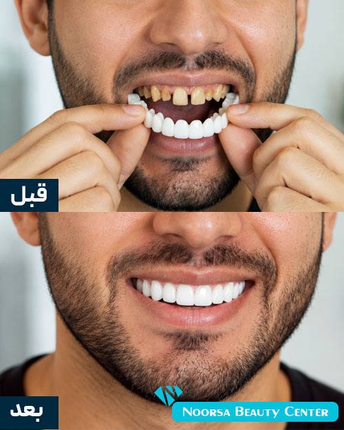 قبل و بعد لمینت متحرک