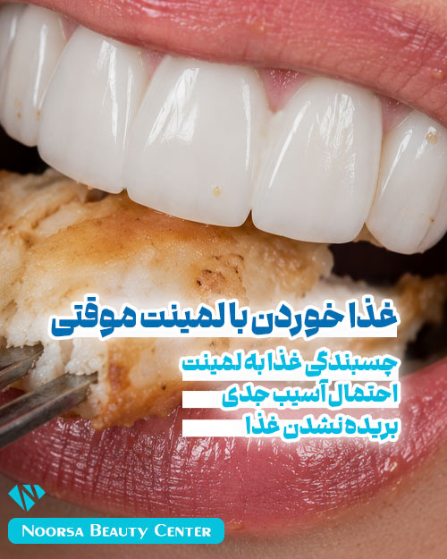 غذا خوردن با لمینت متحرک