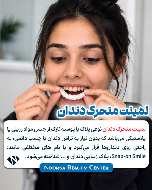 لمینت متحرک دندان