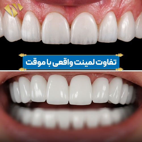 تفاوت لمینت دائمی با متحرک