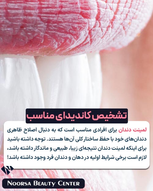 کاندیدای مناسب لمینت دندان