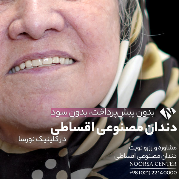 دندان مصنوعی اقساطی در کلینیک نورسا