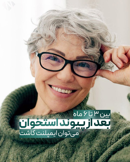 چه مدت بعد از پیوند استخوان میتوان ایمپلنت گذاشت