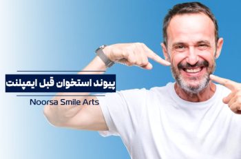 پیوند استخوان برای ایمپلنت