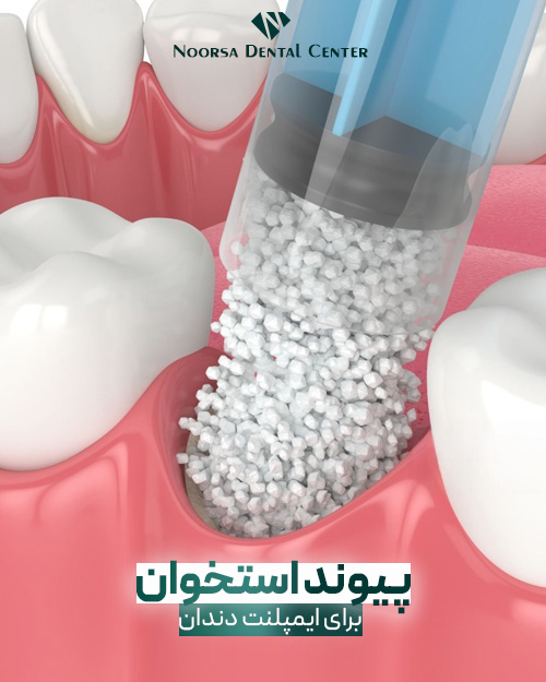 پیوند استخوان برای ایمپلنت دندان