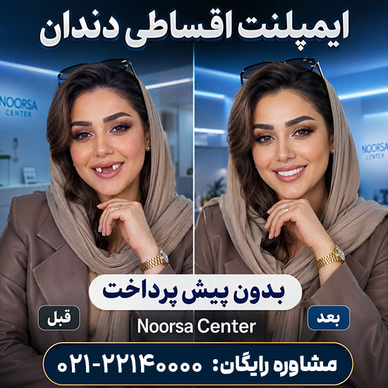 ایمپلنت دندان اقساطی