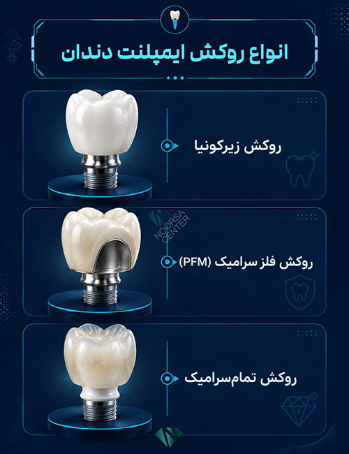 انواع روکش ایمپلنت دندان