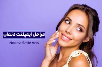 مراحل ایمپلنت دندان